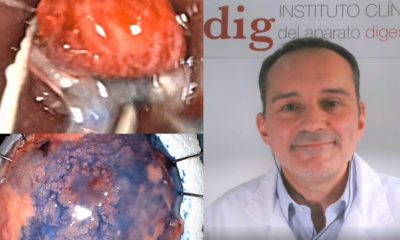 Reseccion de la mucosa y la diseccion de la submucosa en el tubo digestivo explicadas por el Dr. Jose Carlos Marin Gabriel efe sTLKFv