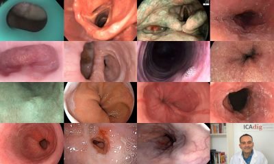 endoscopia bucal y esofagica efe PF1OSD