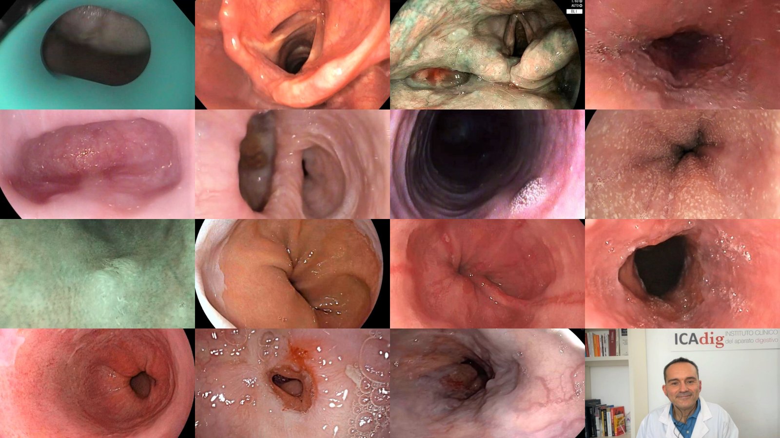 endoscopia bucal y esofagica efe PF1OSD